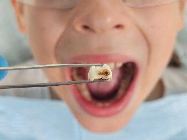 Best Emergency Tooth Extraction in Colesville, MD